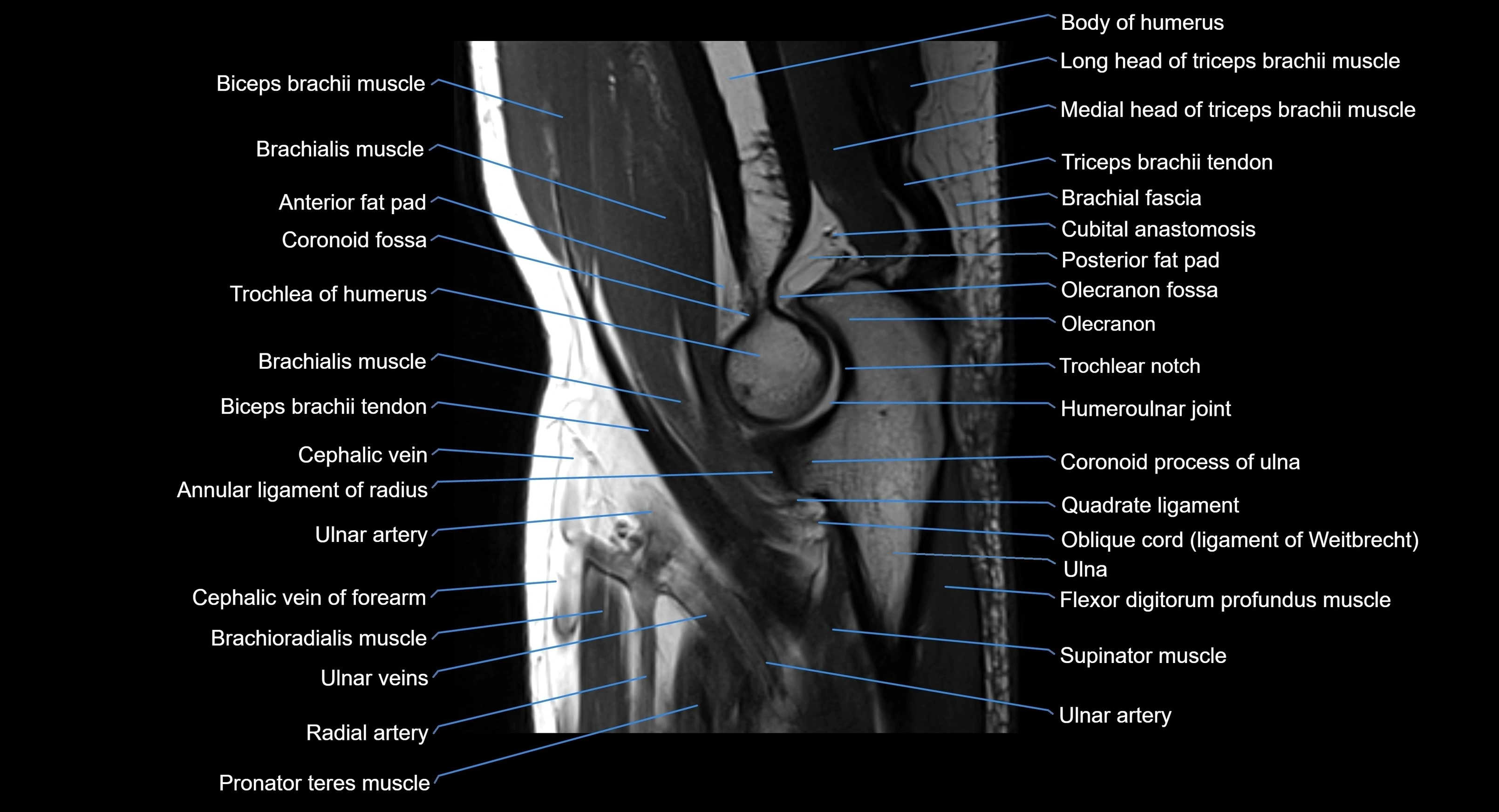 MRI elbow joint  sagittal cross sectional anatomy 3T  radiology  image-img-00001-00014.webp